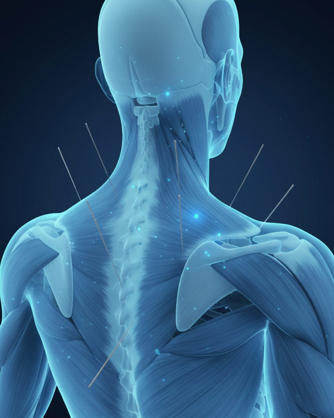 Acupuncture & Dry Needling Edmonton